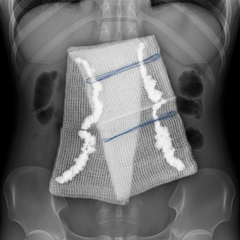 Radiopaque visibility on x-ray